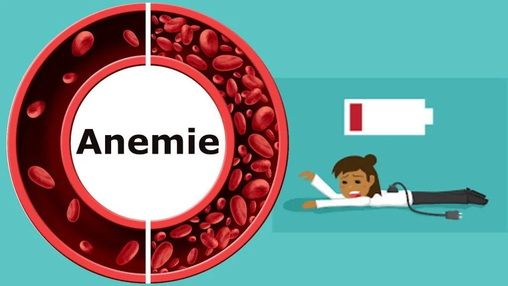 anemie